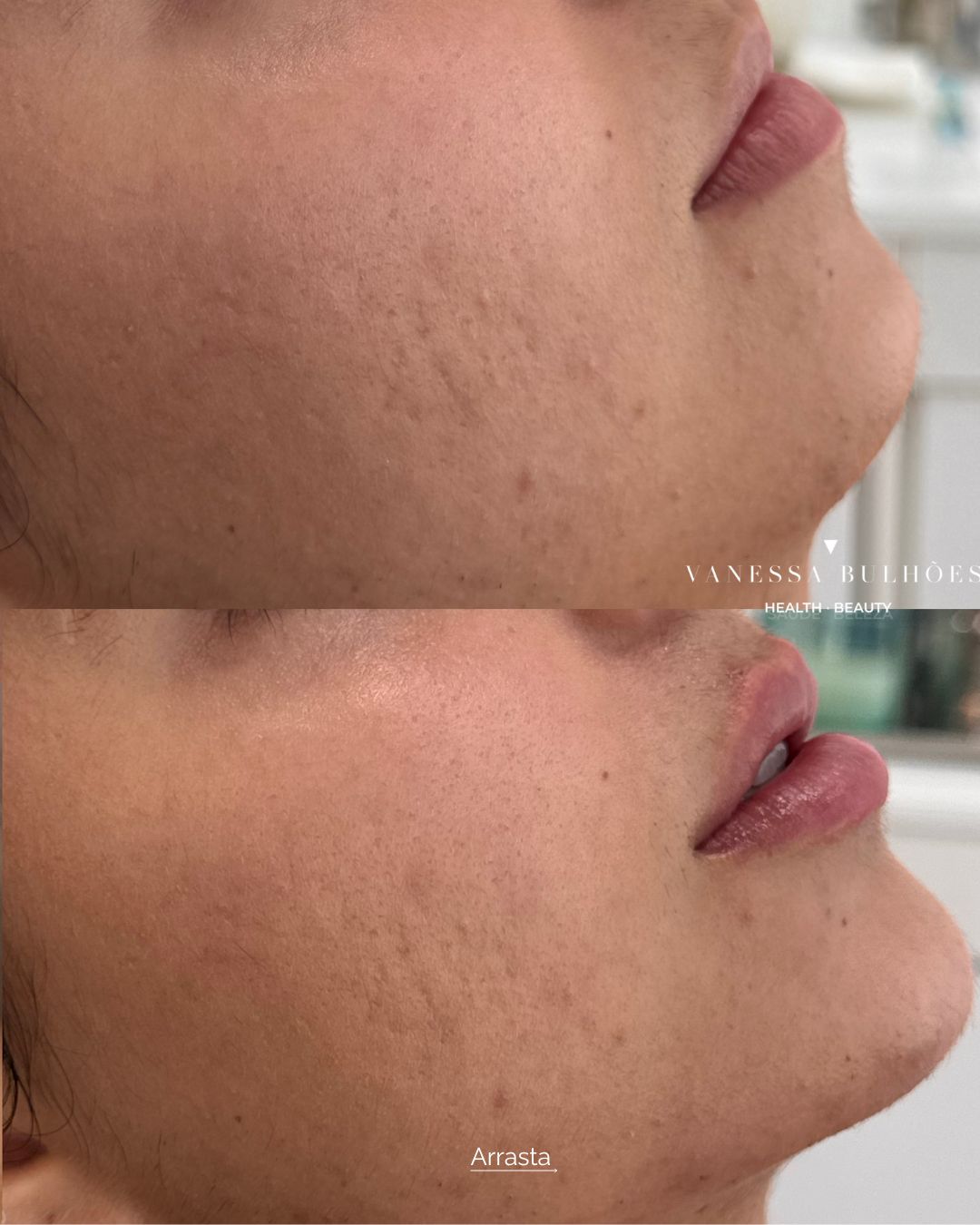 Antes e depois de contorno facial realizado pela Dra. Vanessa Bulhões