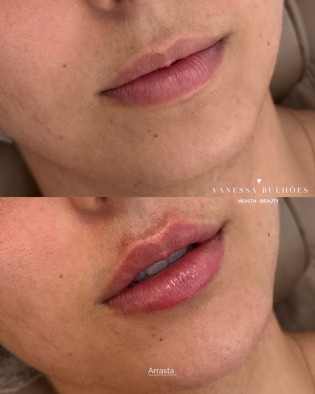 Antes e depois de preenchimento labial realizado pela Dra. Vanessa Bulhões